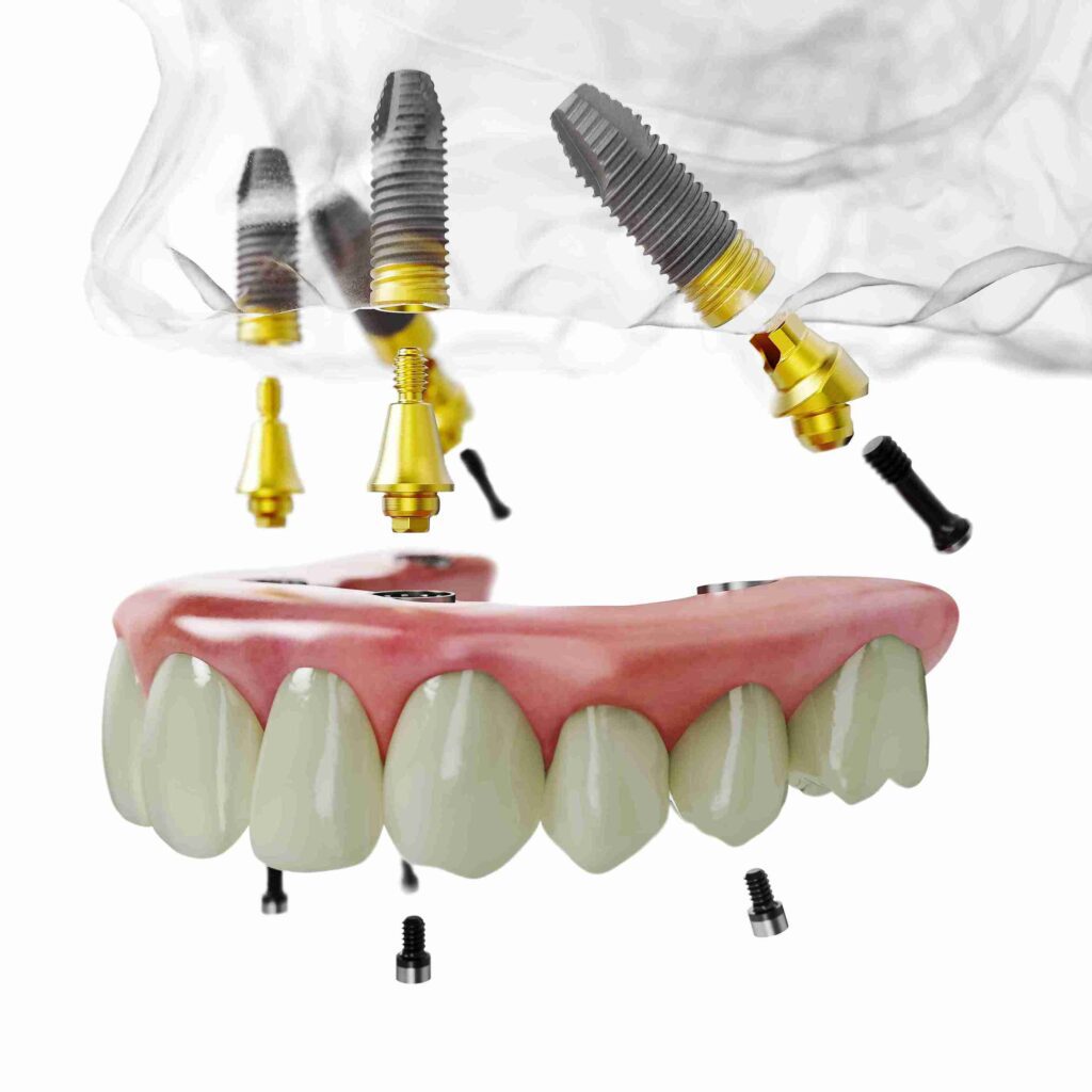All-on-4® Dental Implants at Aghbashian Dental in Glendale, CA 91202