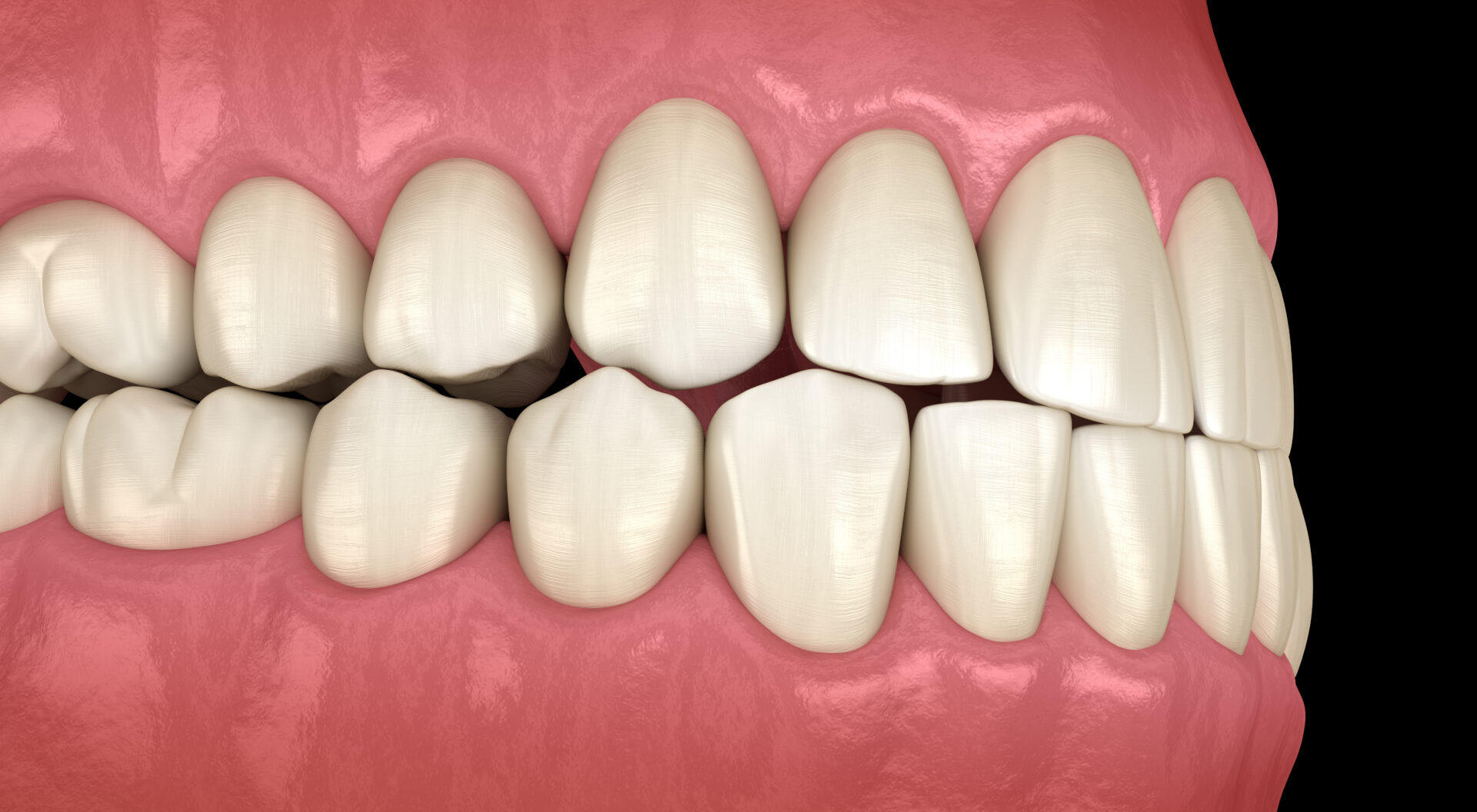 Occlusal Equilibration and Bite Adjustment