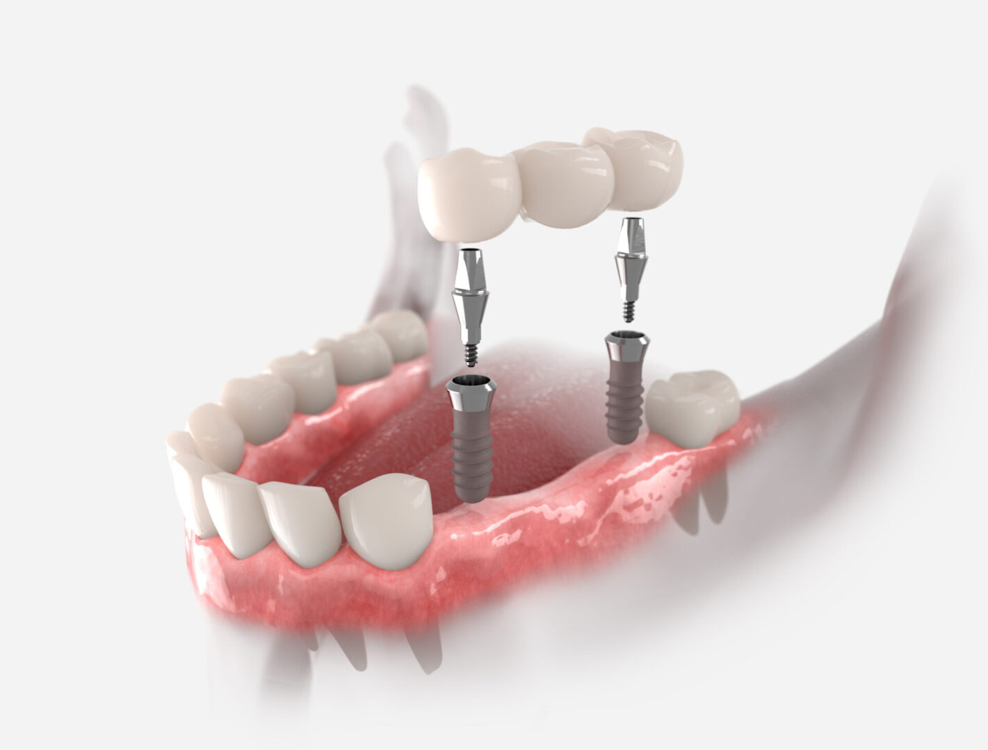 3d illustration of gums with dental bridge, supported by two implants