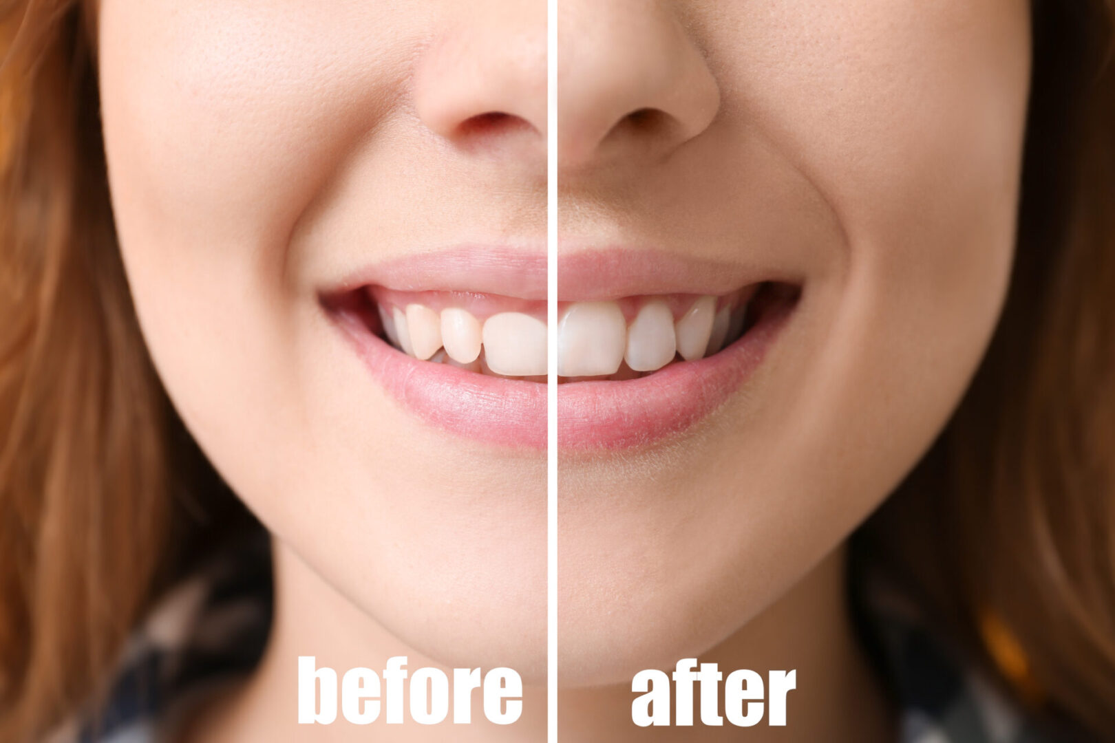 Young woman before and after procedure of gingival plasty, closeup