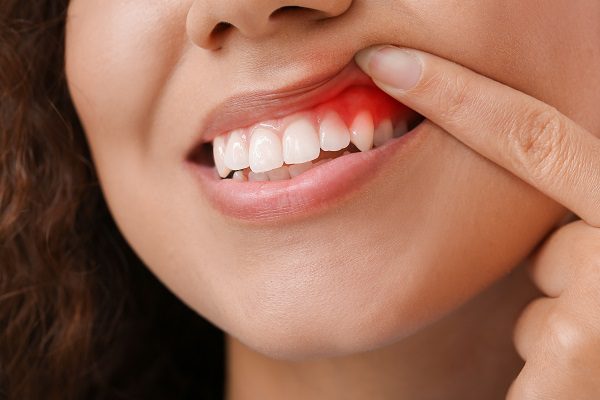 Woman,With,Gum,Inflammation,,Closeup