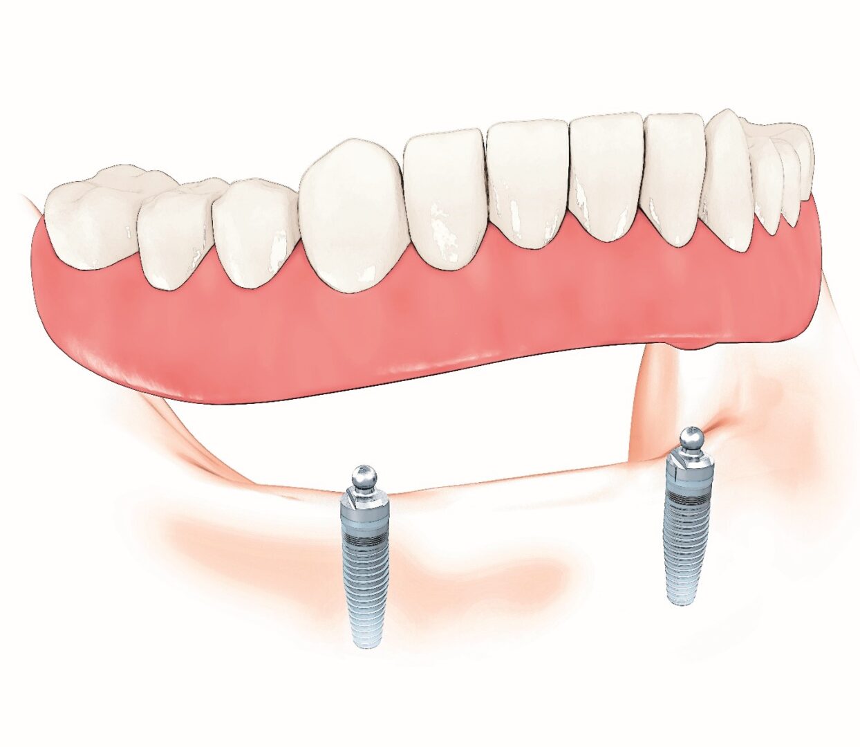 Enhance the power of your Smile Affordable Implantsupported Removable