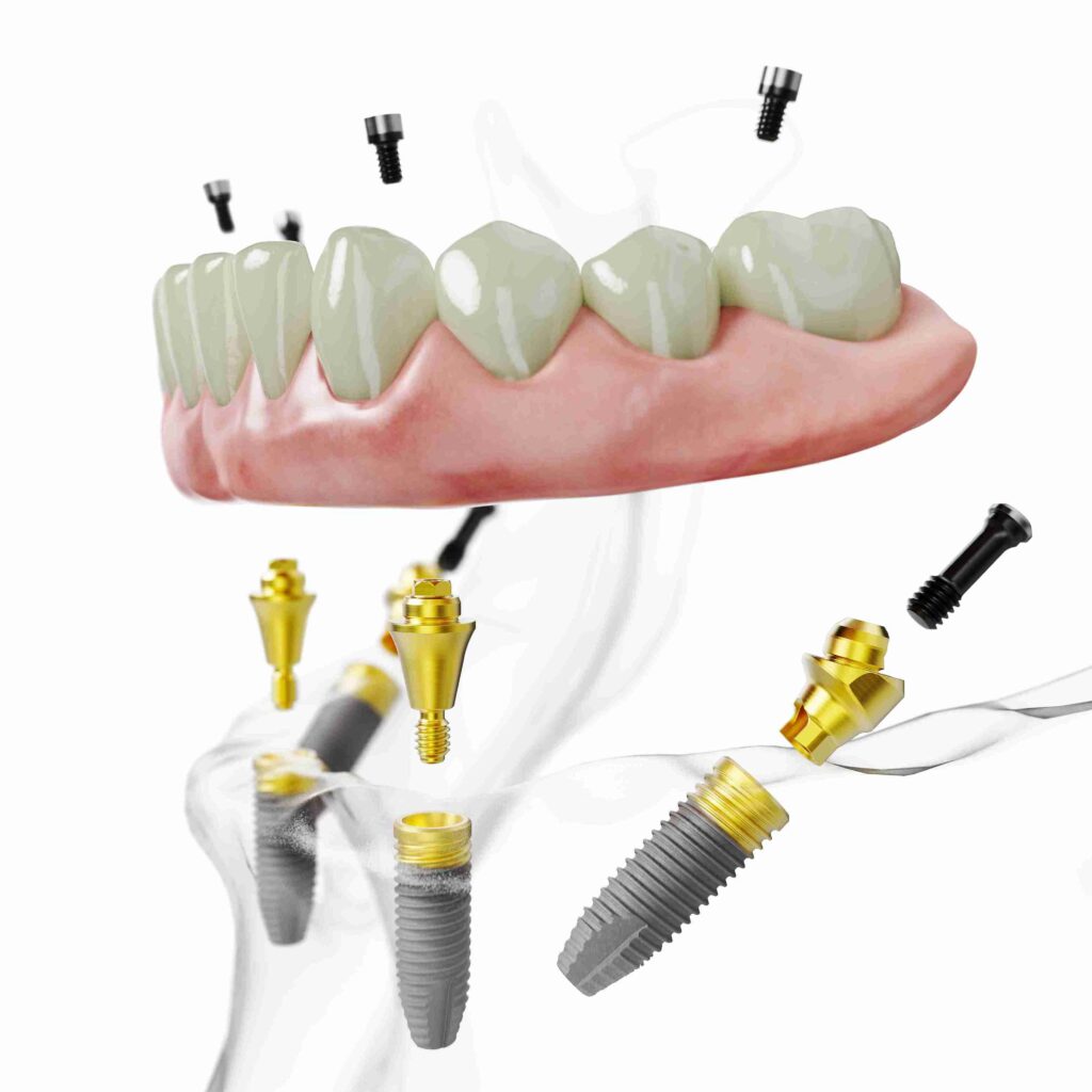 All-on-4 dental implants at Aghbashian Dental in Glendale, CA 91202, showing a fixed full-arch restoration for a natural and permanent smile.