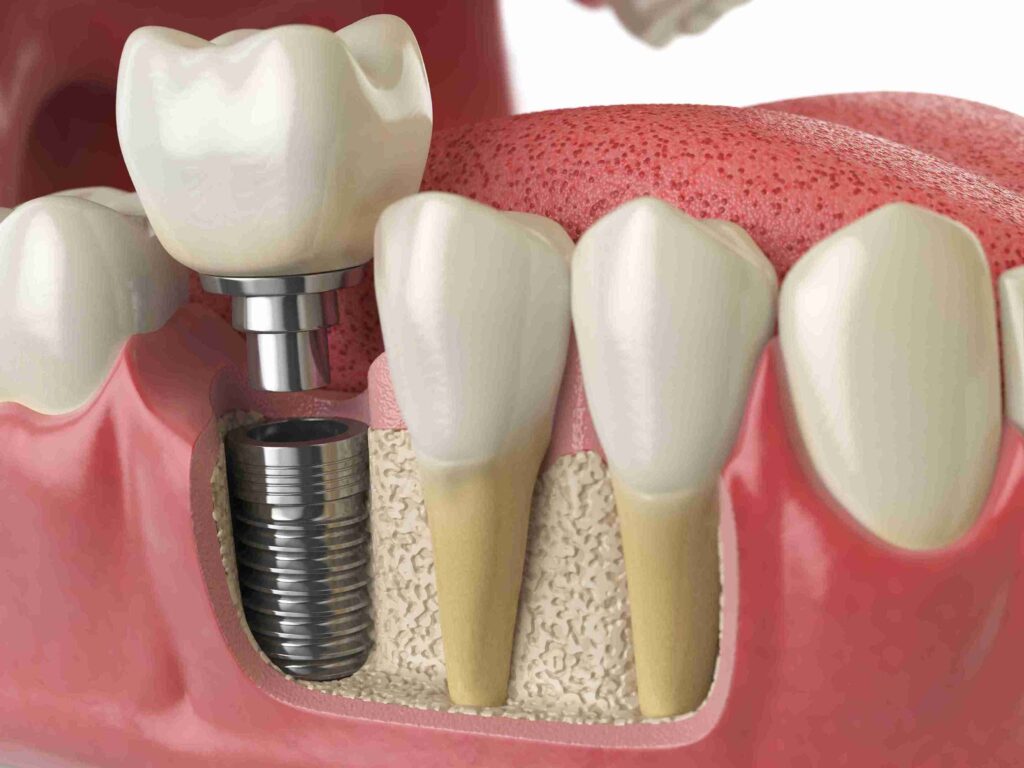 Professional dental implant restoration at Aghbashian Dental in Glendale, CA 91202, showing a high-tech approach to permanent tooth replacement for local patients.