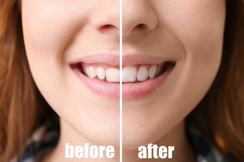 Before and after comparison of a gummy smile treatment using soft tissue laser dentistry to reshape the gum line at Aghbashian Dental in Glendale, CA 91202.