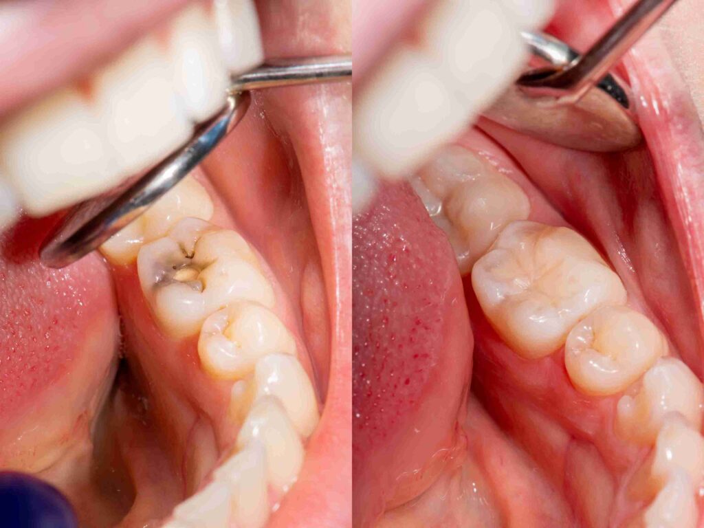 Close-up of a natural-looking, highly aesthetic white restoration on a tooth by Dr. Nova Aghbashian in Glendale, CA 91202.