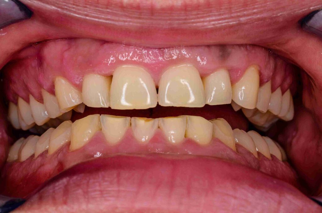 Professional illustration of a dental guard and jaw alignment therapy used for treating teeth grinding (bruxism) and clenching at Aghbashian Dental in Glendale, CA 91202.