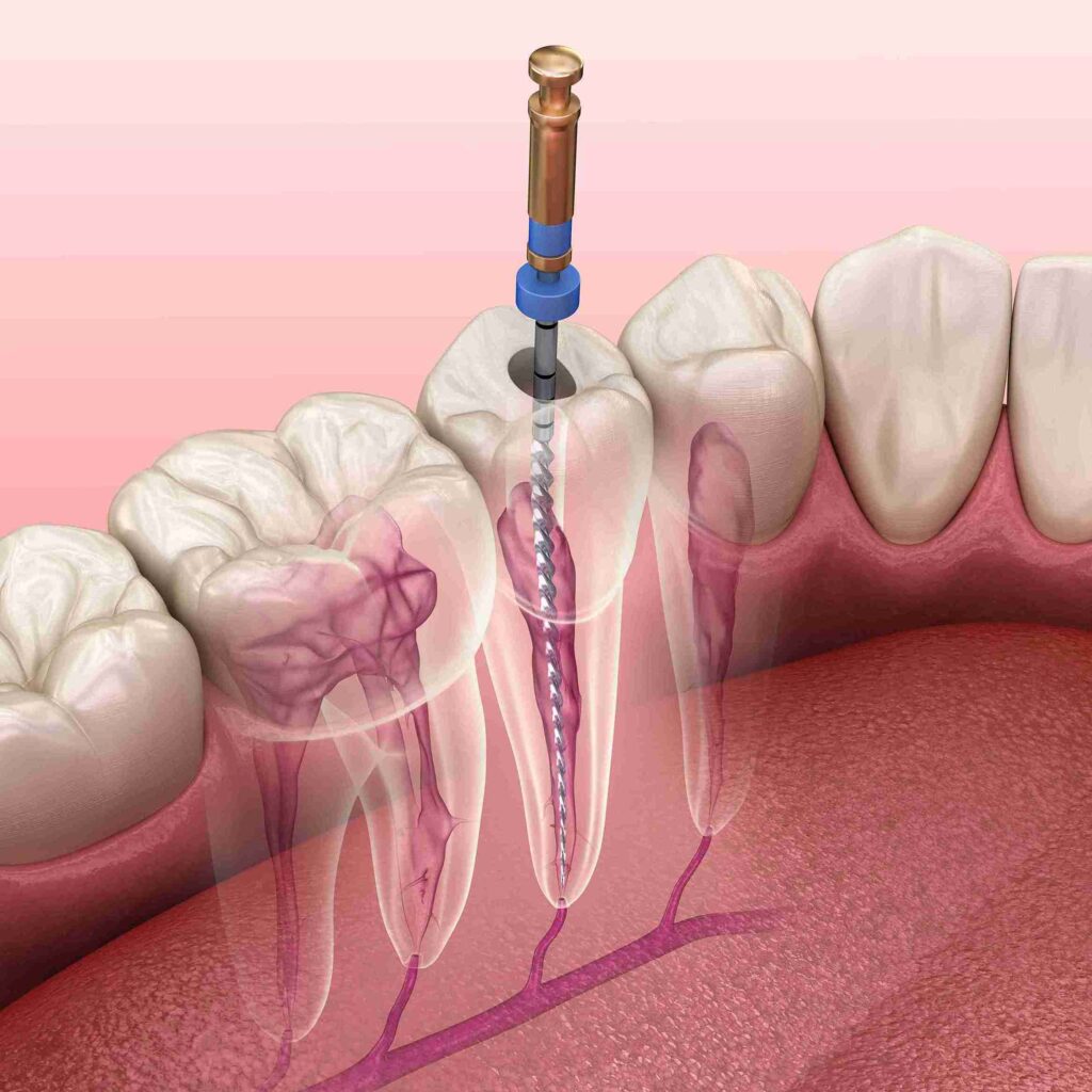 Professional dentist performing a comfortable root canal treatment at Aghbashian Dental in Glendale, CA 91202 to save a natural tooth and relieve pain.