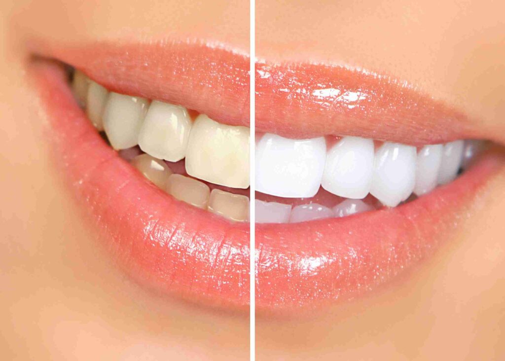A bright, healthy smile showing the results of professional teeth whitening at Aghbashian Dental in Glendale, CA 91202.