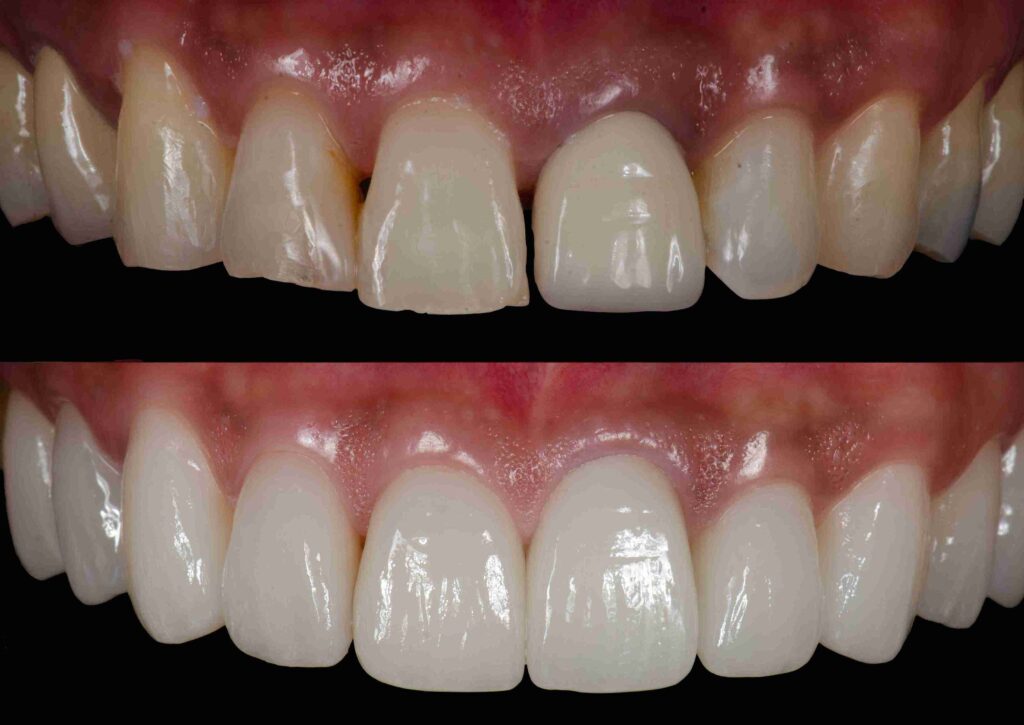 Before and after comparison of a porcelain veneers smile makeover in Glendale, CA at Aghbashian Dental.