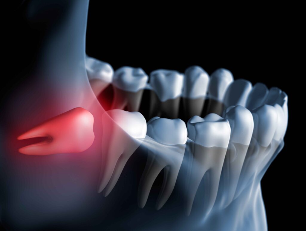 Professional wisdom teeth extraction at Aghbashian Dental in Glendale, CA 91202, focusing on patient comfort and safe surgical removal of impacted third molars.